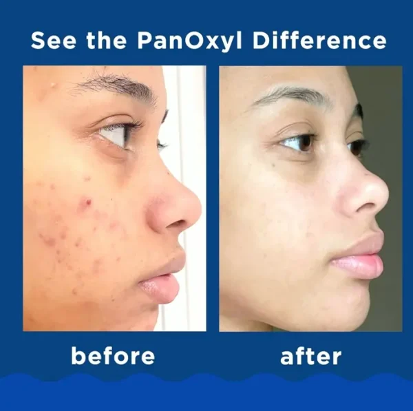 PanOxyl Pimple Cleanser Benzoyl Peroxide 10% Power, 5.5 Oz